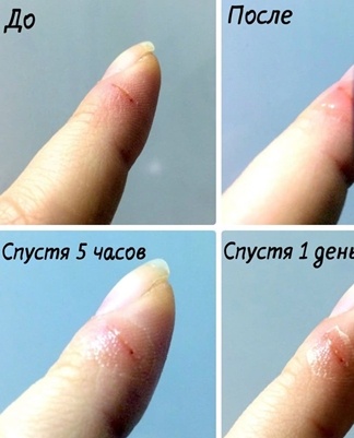 action of bf 6 glue for wounds