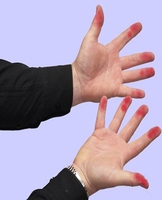 After applying Fukortsin to the skin, red spots remain visible for 5-7 days.