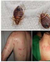 20 ways to get rid of lice fast at home