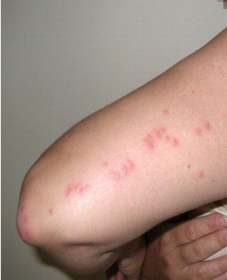 Both chemical and natural remedies are used to remove lice from the body and hair and to treat damaged skin.